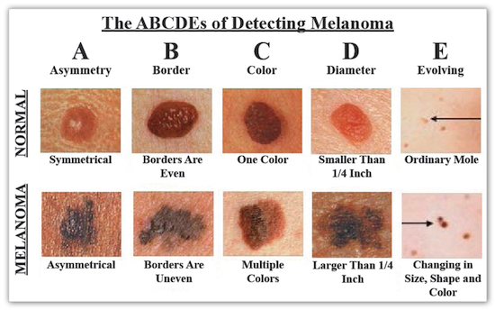 signs-of-skin-cancer