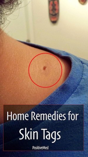 home remedies for skin tags