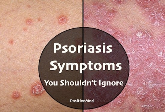 psoriasis symptoms