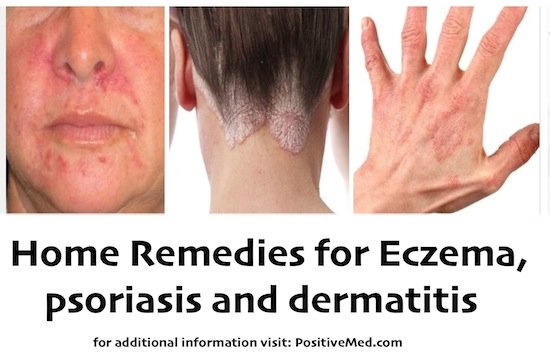 dermatitis home remedies