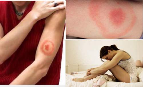 Lyme Disease is Common and Dangerous- How to Spot the Symptoms