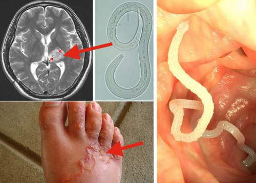 These Internal Parasites Are Eating You Alive