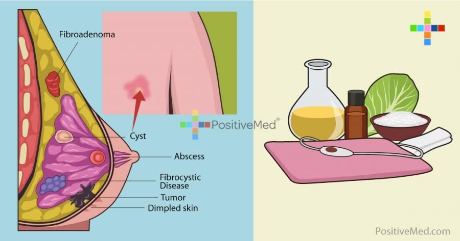 6-natural-remedies-to-get-rid-of-breast-cysts