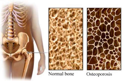 Dairy Destroys Your Bones