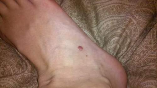 Moles In Feet 22