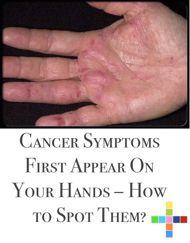 Cancer Symptoms First Appear On Your Hands How to Spot Them