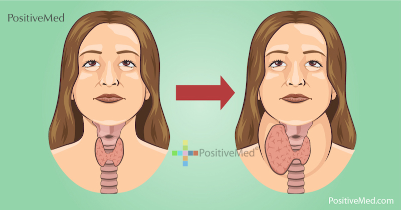 foods high in iodine for hypothyroidism