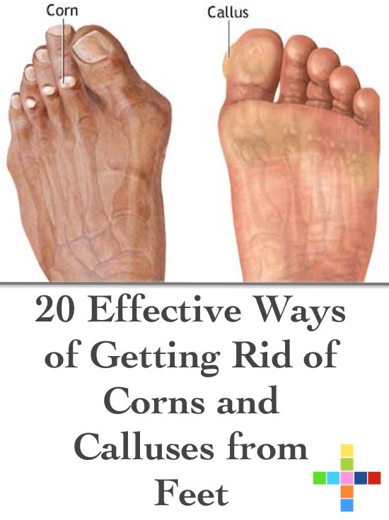 20-effective-ways-of-getting-rid-of-corns-and-calluses-from-feet