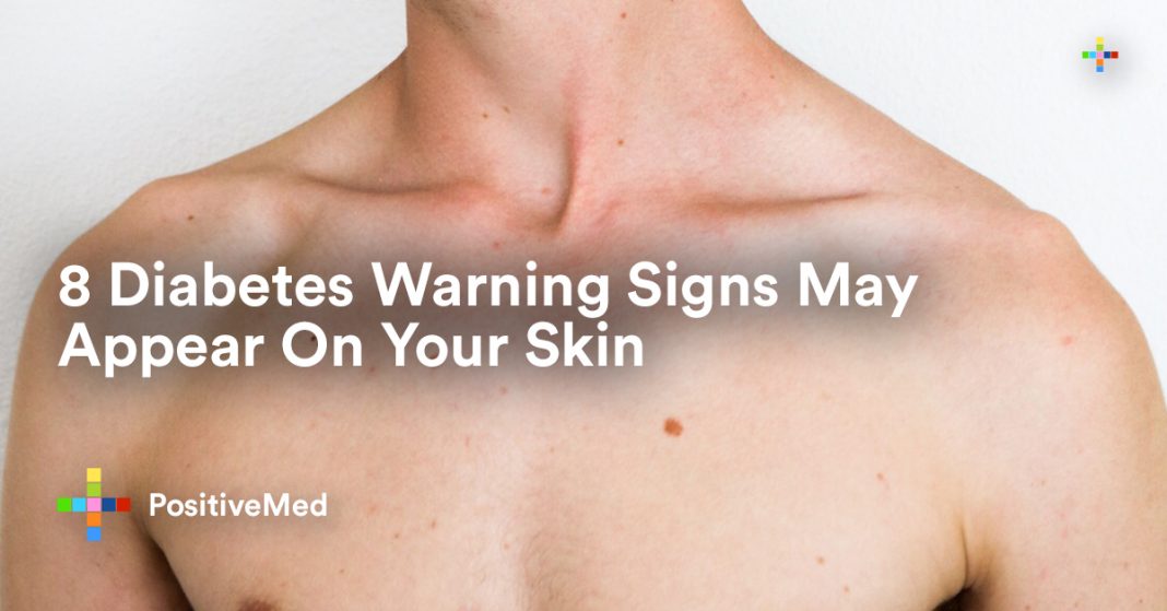 Diabetes Warning Signs May Appear On Your Skin