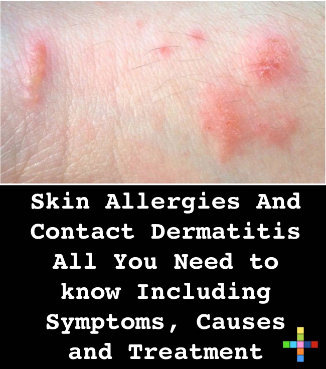 Skin Allergies And Contact Dermatitis All You Need to know