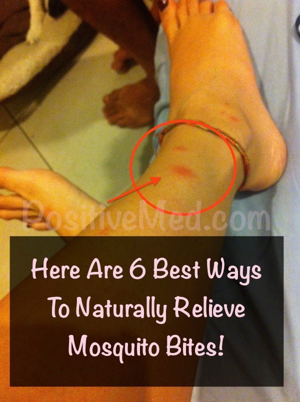 Naturally Relieve Mosquito Bites