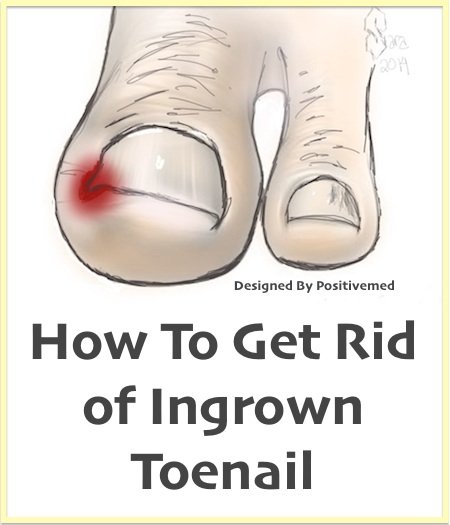 How To Get Rid of Ingrown Toenail