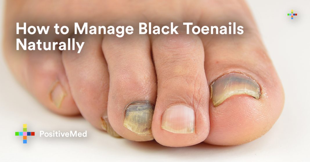 how-to-manage-black-toenails-naturally