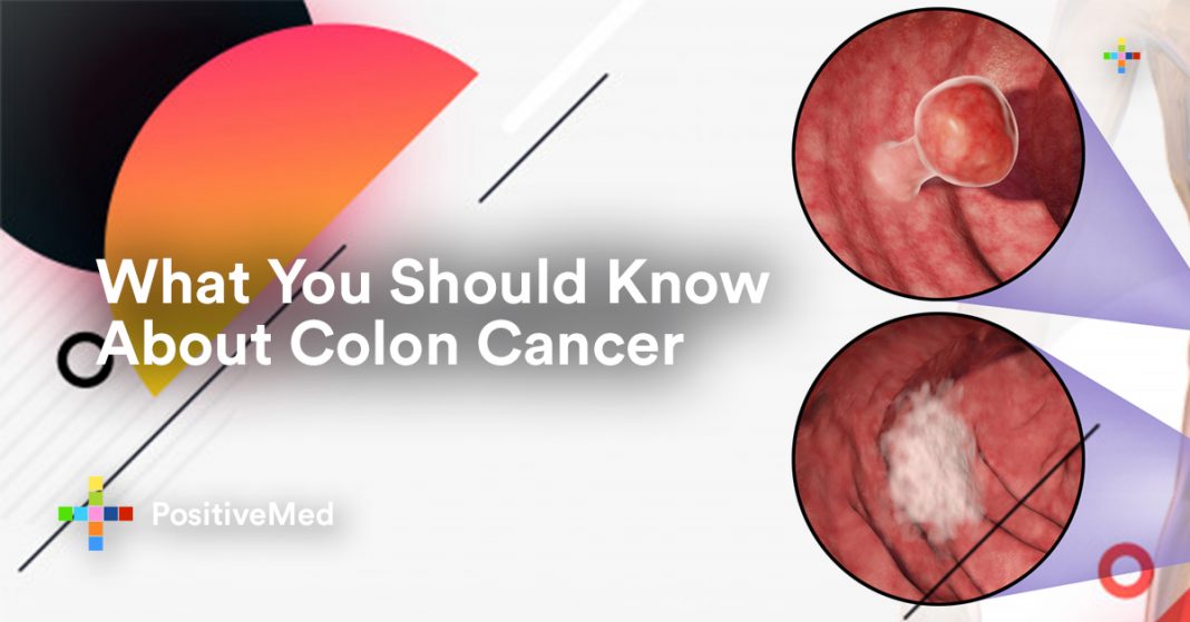 What You Should Know About Colon Cancer - PositiveMed