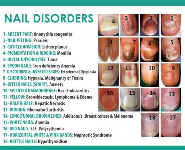 5. Fungal Nail Infection: What Nail Color to Avoid - wide 9