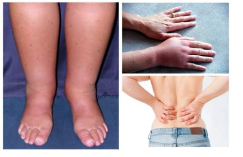 If Your Body Is Swelling It Might Be a Sign of an Advanced Illness