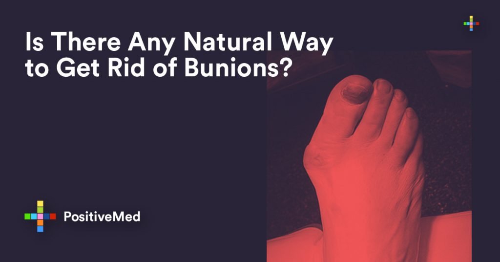 Is There Any Natural Way to get Rid of Bunions