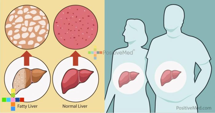 Know The 9 Signs of Liver Damage Before It's Too Late! - PositiveMed