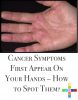 Cancer Symptoms First Appear On Your Hands - How to Spot Them ...