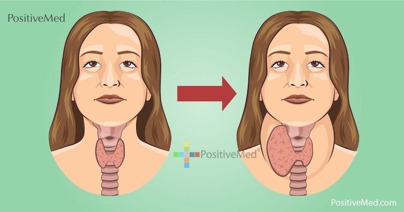 These 2 Iodine Rich Foods Destroy Your Thyroid from the Inside