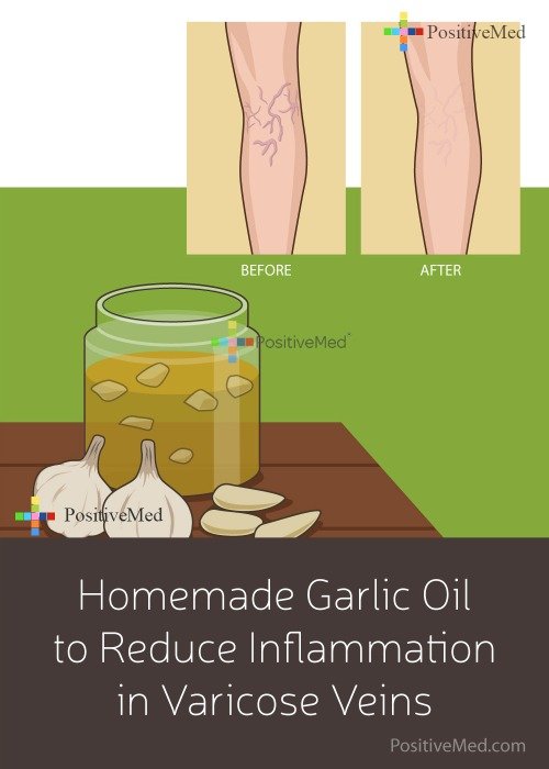Homemade Garlic Oil to Reduce Inflammation in Varicose Veins