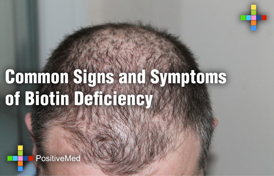 Common Signs and Symptoms of Biotin Deficiency PositiveMed