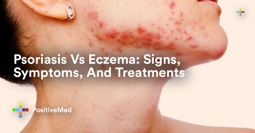 Psoriasis Vs Eczema Signs Symptoms And Treatments Positivemed