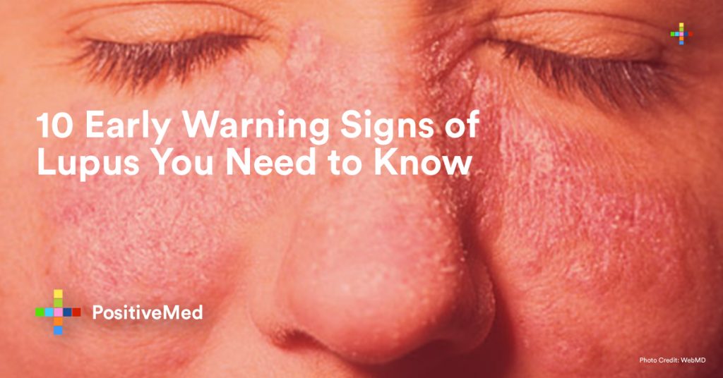 10 Early Warning Signs of Lupus You Need to Know