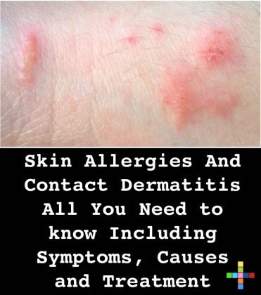 Skin Allergies And Contact Dermatitis: All You Need to know