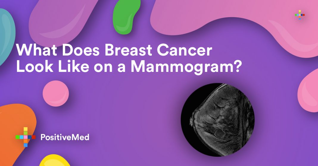 What Does Breast Cancer Look Like On A Mammogram? - PositiveMed