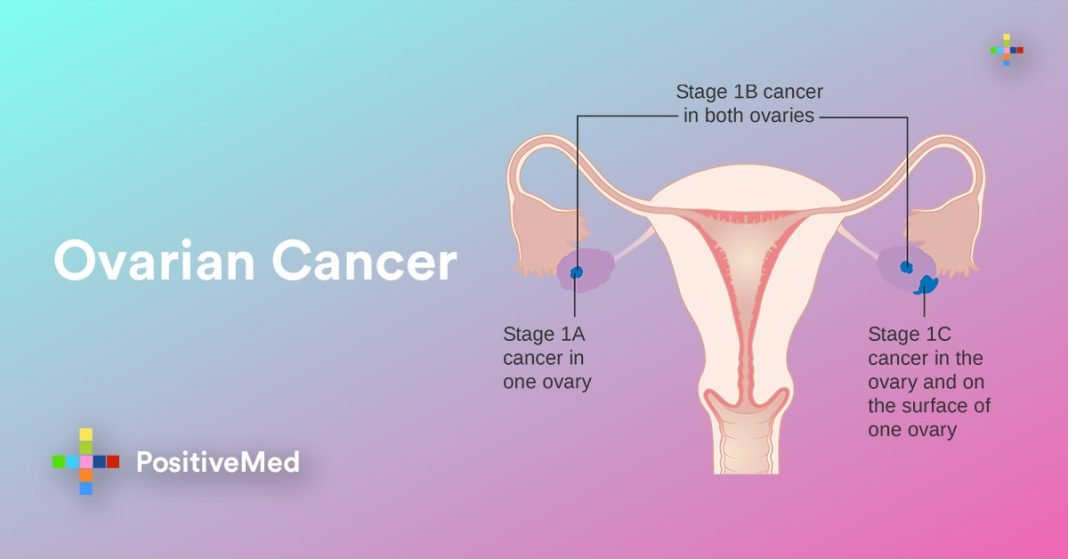 Ovarian Cancer: All You Need To Know- Symptoms And Treatments