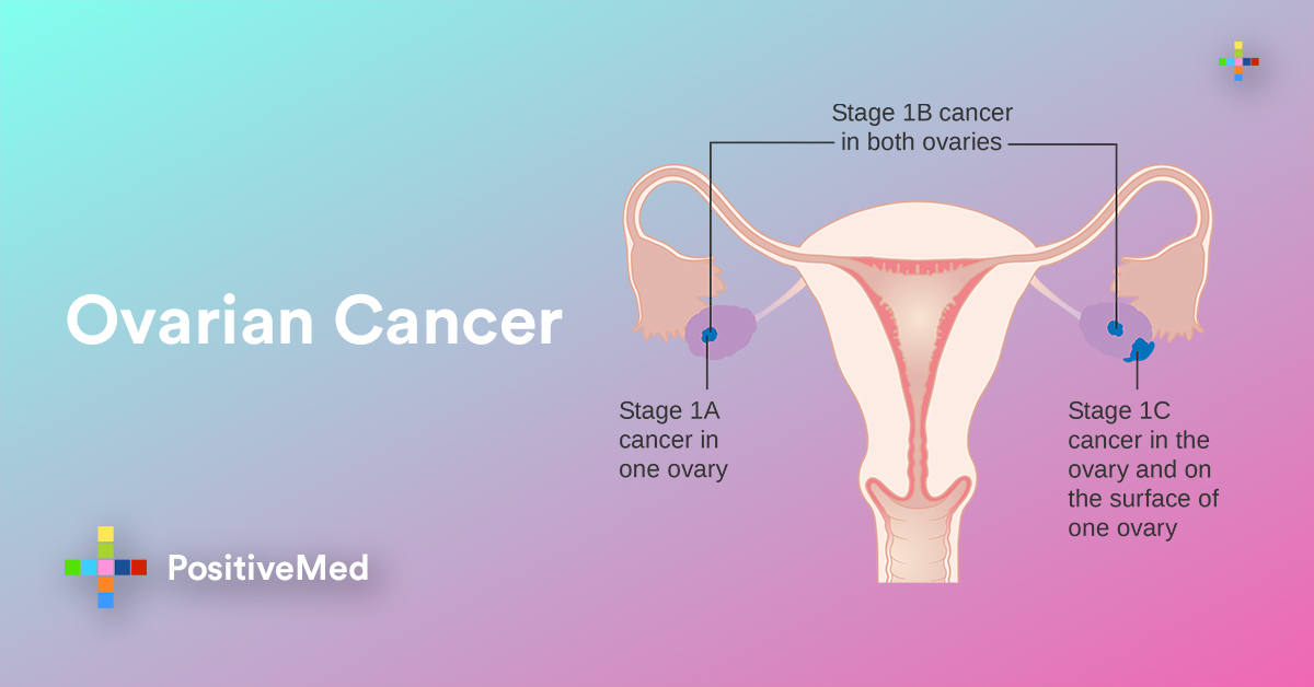 Ovarian Cancer All You Need To Know Symptoms and Treatments