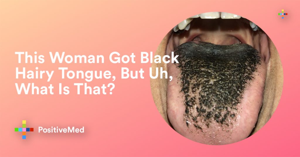 What to Do About Black Hairy Tongue, What Is That?