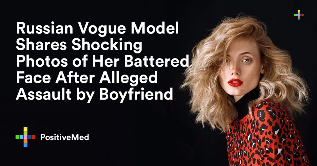 Russian Vogue Model Shares Shocking Photos of Her Bottered Face After Alleged Assault By Boyfriend