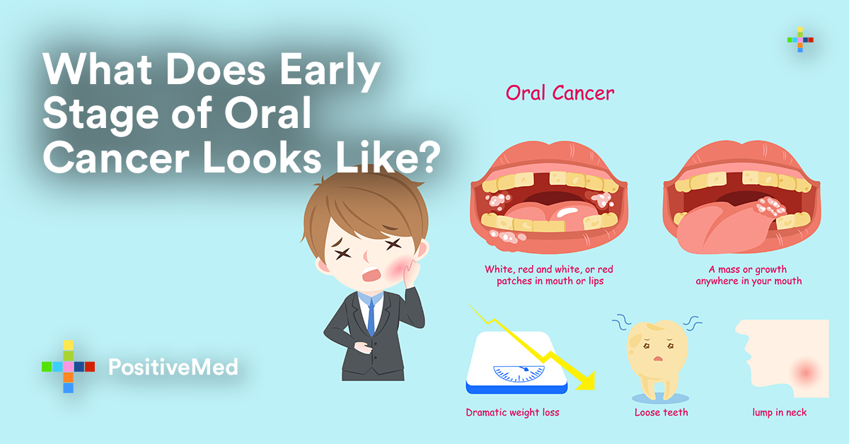 What Do Early Stages of Oral Cancer Look Like? - PositiveMed