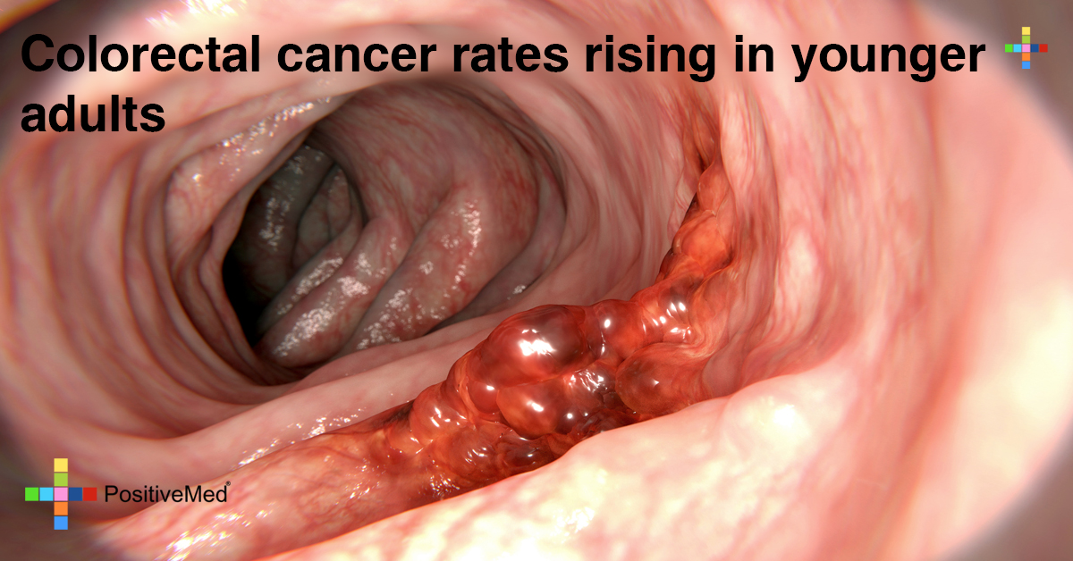 Colorectal Cancer Rates Rising in Younger Adults  