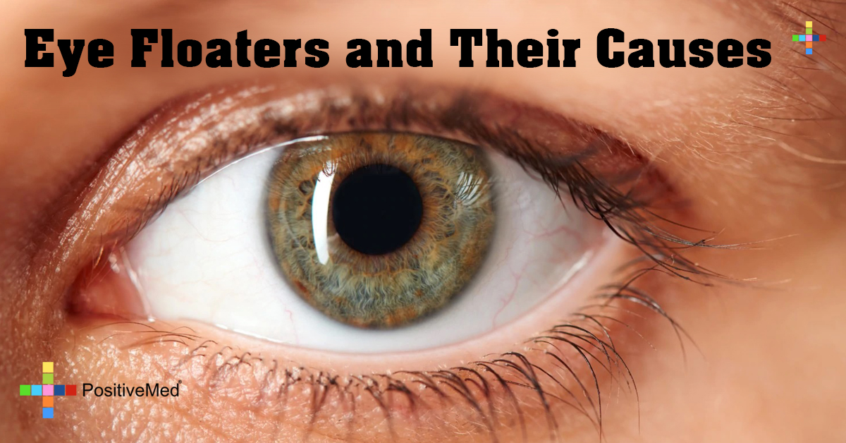 Eye Floaters and Their Causes