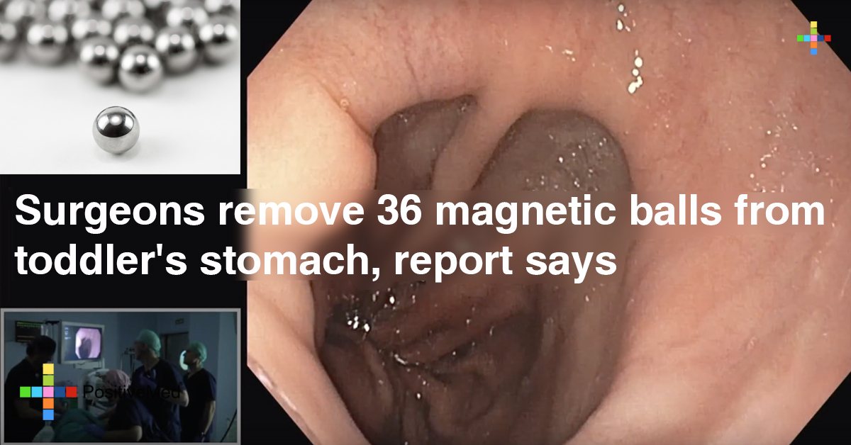 Surgeons Remove 36 Magnetic Balls from Toddler's Stomach, Report Says 