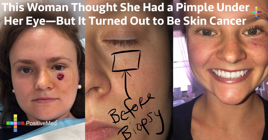 This Woman Thought She Had a Pimple Under Her Eye—But It Turned Out to Be Skin Cancer
