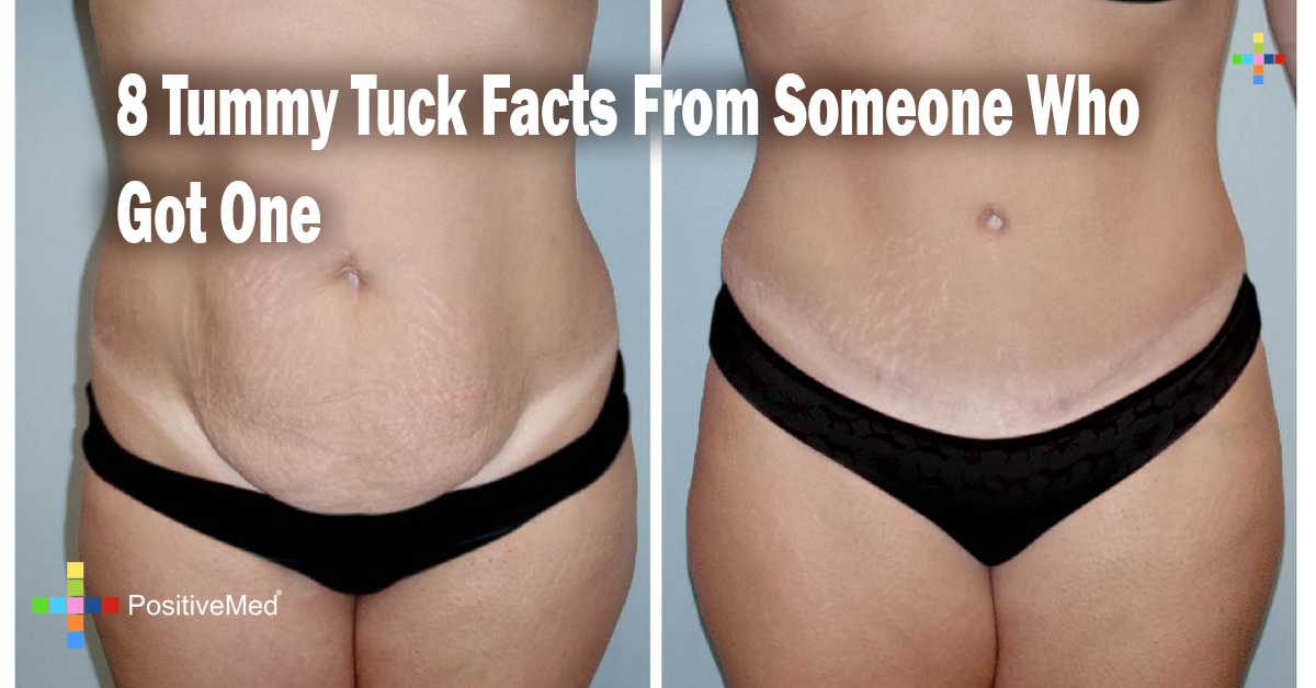 8 Tummy Tuck Facts From Someone Who Got One