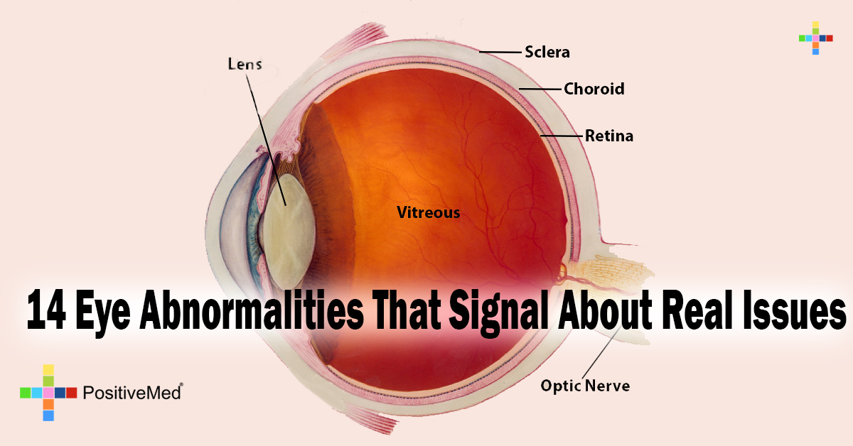 14 Eye Abnormalities That Signal About Real Issues - PositiveMed