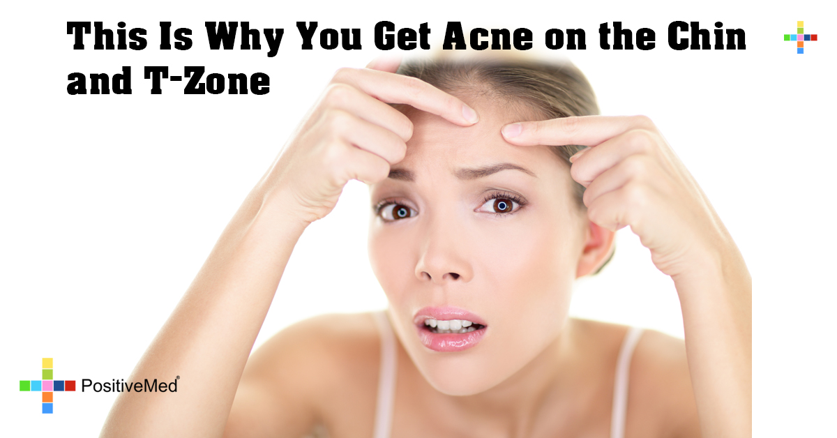 This Is Why You Get Acne on the Chin and T-Zone