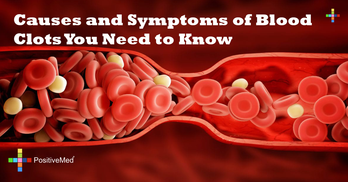 Causes and Symptoms of Blood Clots You Need to Know