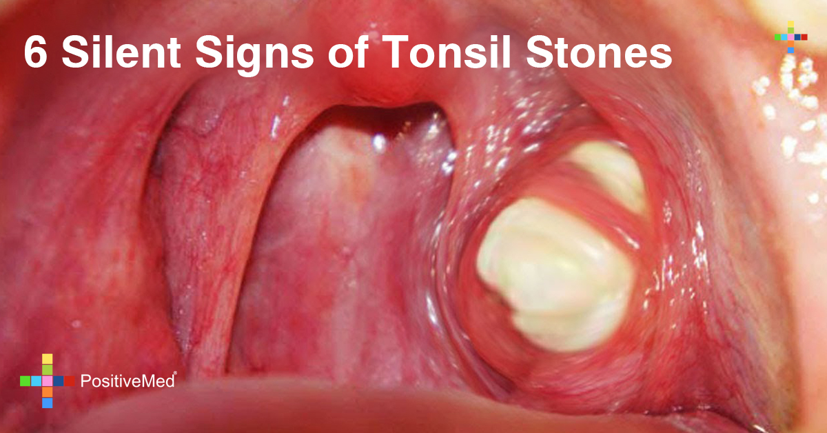 6 Silent Signs of Tonsil Stones You Need to Be Aware of 