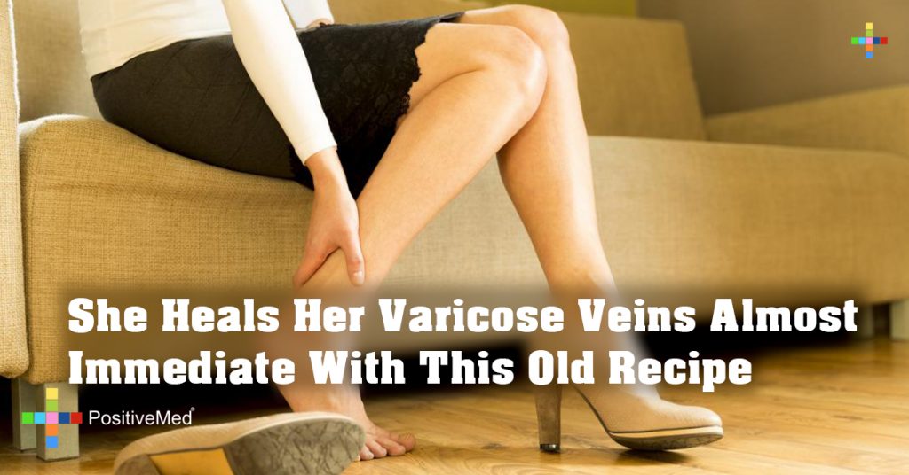 She Heals Her Varicose Veins Almost Immediate With This Old Recipe