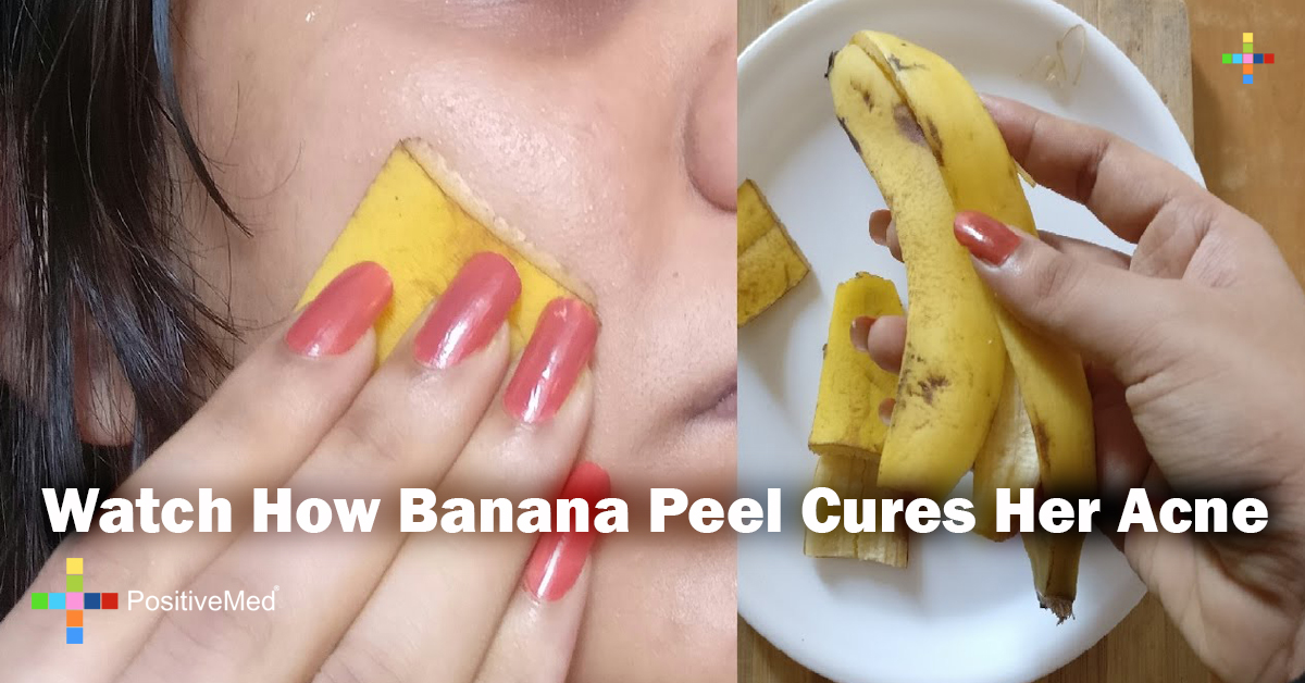 Watch How Banana Peel Cures Her Acne