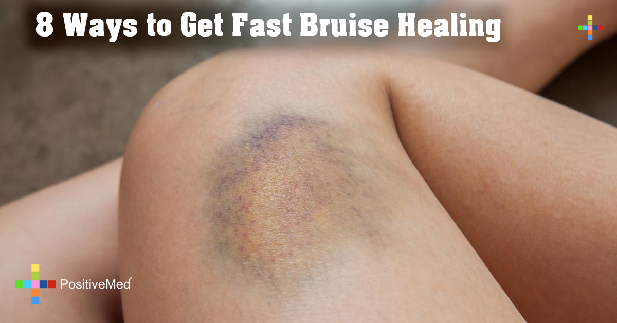 8 Ways to Get Fast Bruise Healing