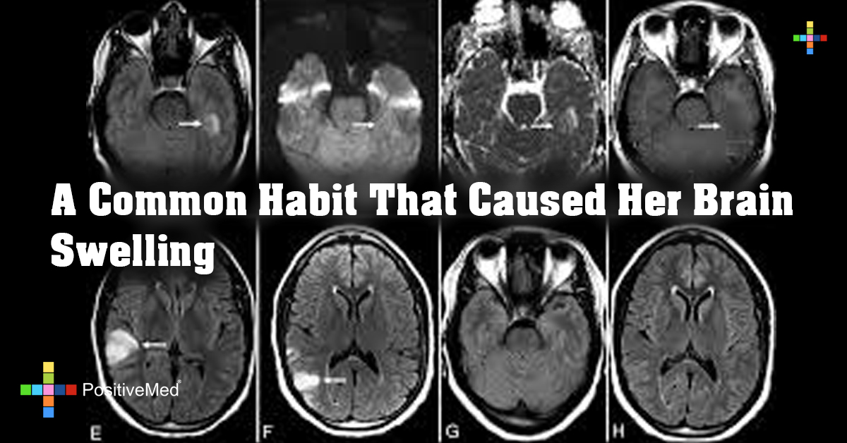 A Common Habit That Caused Her Brain Swelling