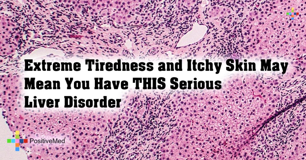 Extreme Tiredness and Itchy Skin May Mean You Have THIS Serious Liver ...