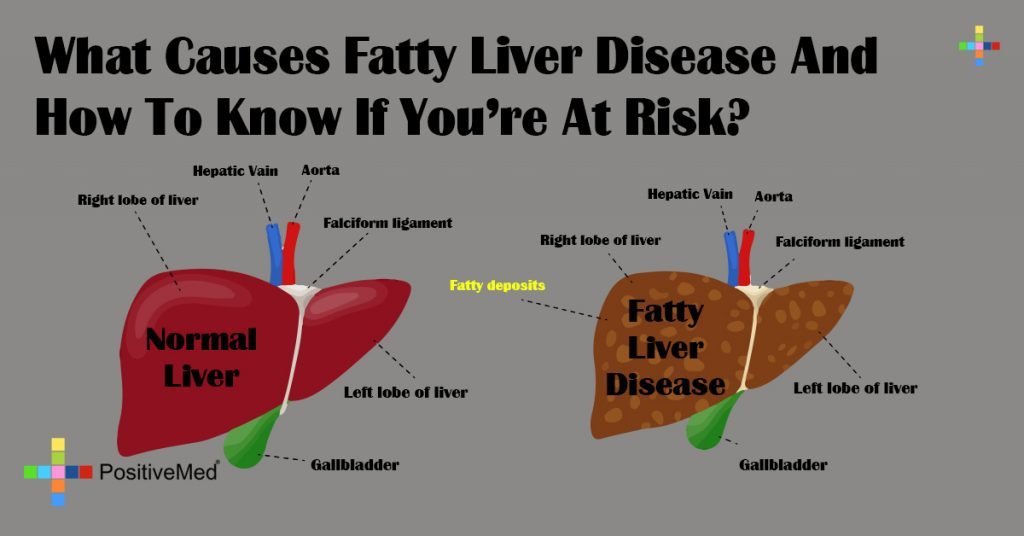 What Causes Fatty Liver Disease And How To Know If You're At Risk?